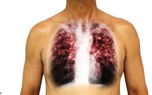 肺癌可以吃棚瓜,天然食疗新选择