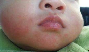 小孩吃瓜嘴巴周边红肿,嘴巴周边红肿的烦恼与对策